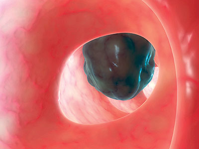 دراسة طبية أميركيةعن وقايات سرطان القولون دراسة طبية أميركيةعن وقايات سرطان القولون