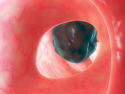 دراسة طبية أميركيةعن وقايات سرطان القولون