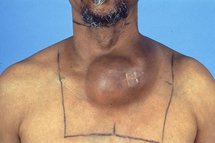 دراسة علمية بريطانية : الرجال أكثر عرضة للموت بالسرطان من النساء دراسة علمية بريطانية : الرجال أكثر عرضة للموت بالسرطان من النساء