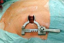 تقنية استرالية جديدة لترميم الثدي المستأصل لدى المصابات بالسرطان