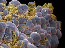 اكتشاف جسم مضاد يهاجم الخلايا السرطانية في البروستات