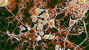 هناك احتمال أن تنجح الخلايا الجذعية في علاج التصلب المتعدد