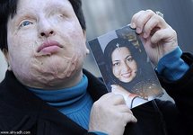 التعويض أم ضغط السلطات وراء تنازل إيرانية عن القصاص ممن أصابها بالعمى
