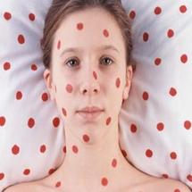   حيرة طبية لموت فتاة بالتهاب عدوى الحصبة بعد 12 عاما من إصابتها