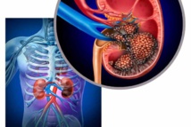 الكشف عن أعراض نوع من سرطان الكلى يصعب تشخيصه الكشف عن أعراض نوع من سرطان الكلى يصعب تشخيصه