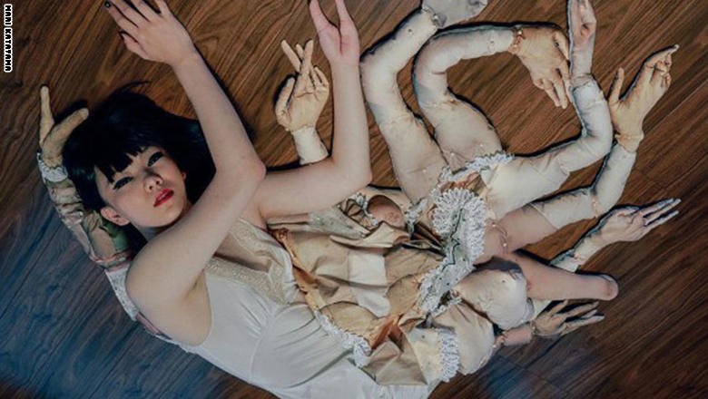 بُترت ساقيها..فزرعت "عشرات" الأرجل بجسدها