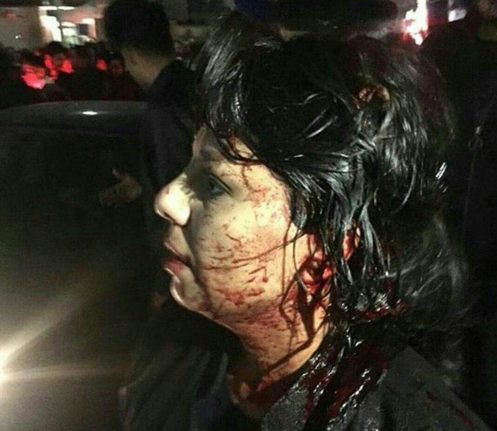 اثار الدماء على وجه ايرانية تعرضت للضرب من قبل رجال الحرس الثوري