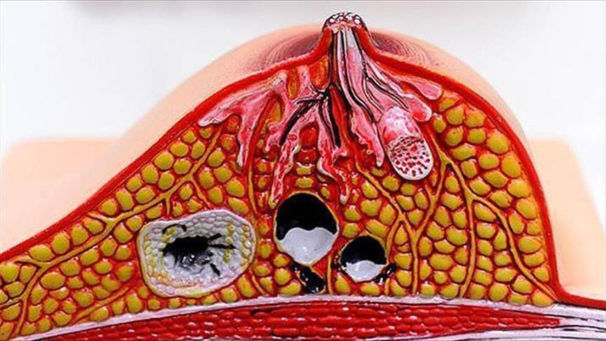 دراسة: عقار لسرطان الثدي قد يضعف وظائف المخ