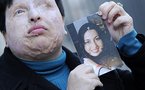إيرانية تتنازل في أخر لحظة عن القصاص ممن ألقى على وجهها مادة حمضية وأصابها بالعمى