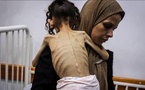 "أوتشا": الوضع في غزة فاق الكارثة ووفيات يومية مرتبطة بالجوع